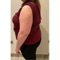 ARM FAT REDUCTION - SINGLE SESSION BEFORE