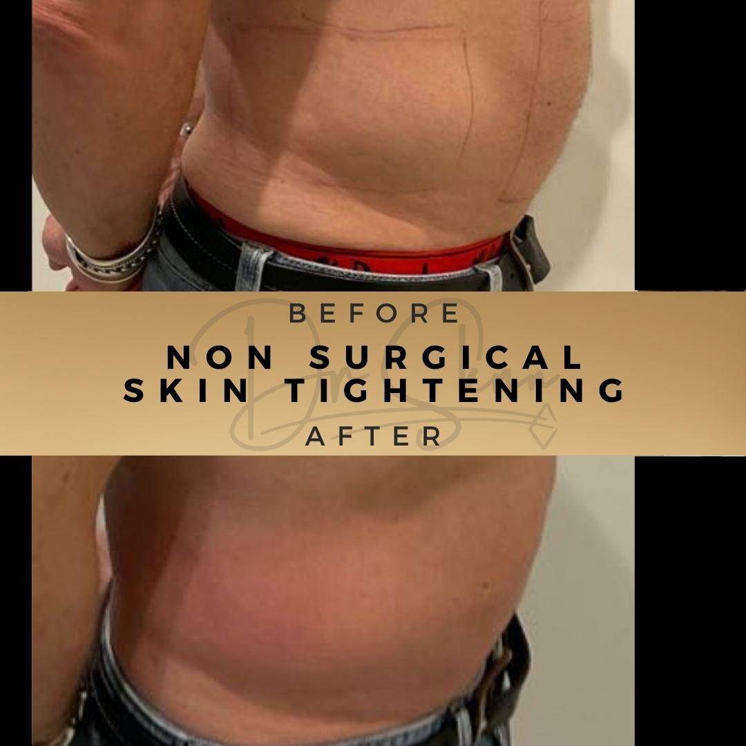 Non Surgical Skin Tightening Wilmslow Before & After Dr Sknn