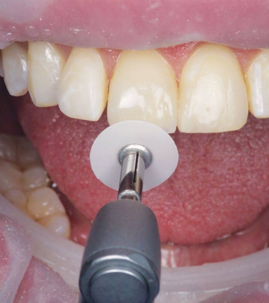 White superfine polishing disc approaching upper tooth getting restored