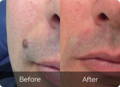 before and after pictures mole remover