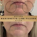 Marionette Line Filler Wilmslow Before & After Dr Sknn