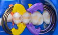 Bioclear Rwin Rings