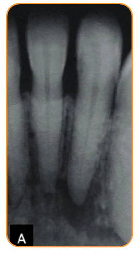 Bio-C Temp case: initial radiograph