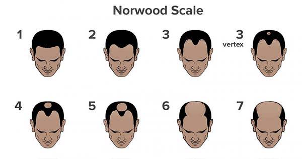 The Norwood Scale for Male Pattern Hair Loss