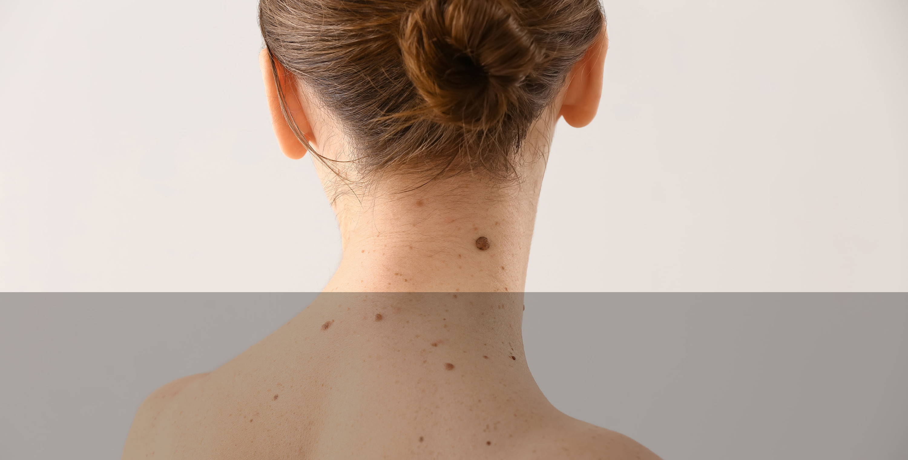 Mole Removal Appointments in Central London