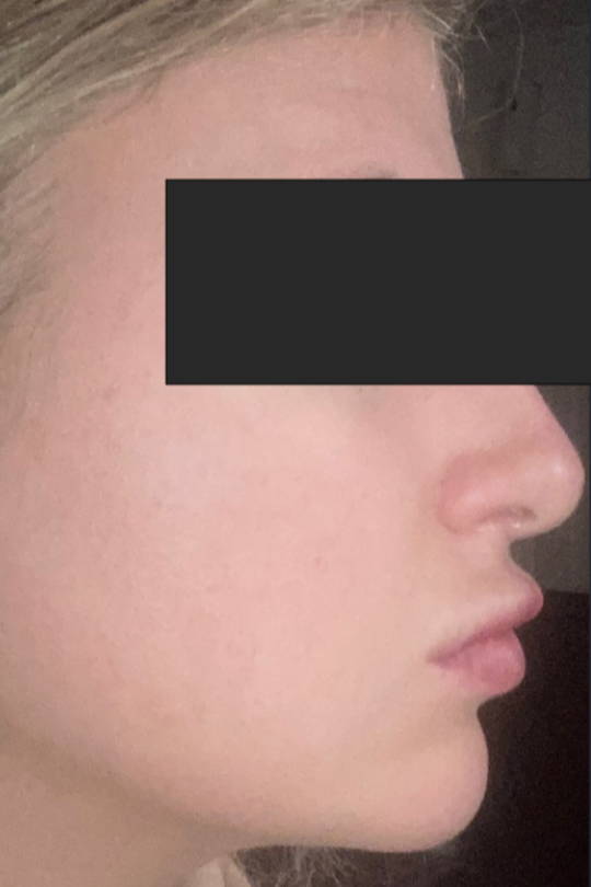 Female face with rosacea after using Natural Elements Sincare