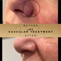 IPL Vascular Thread Vein Removal Wilmslow Dr Sknn Before & After Picture