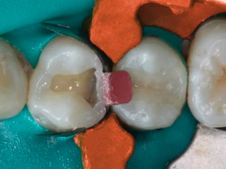 Matrix ring placed between molars