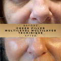 cheek fillers Dr Sknn Before & After Picture