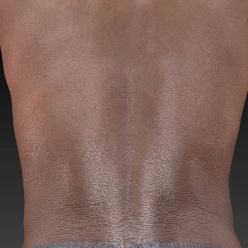 Dr Sknn Dermalux Tri-Wave MD Pigmentation After