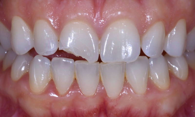 smile with fractured upper central incisor