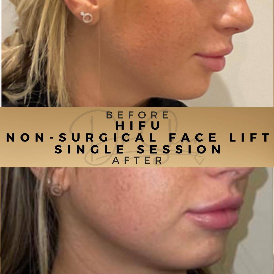 Non-surgical Facelift (HIFU) - Dr Sknn before and after