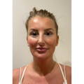 SUBMENTAL | NECK SKIN TIGHTENING AFTER