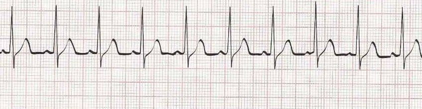 Wandering atrial pacemaker (p waves look different)