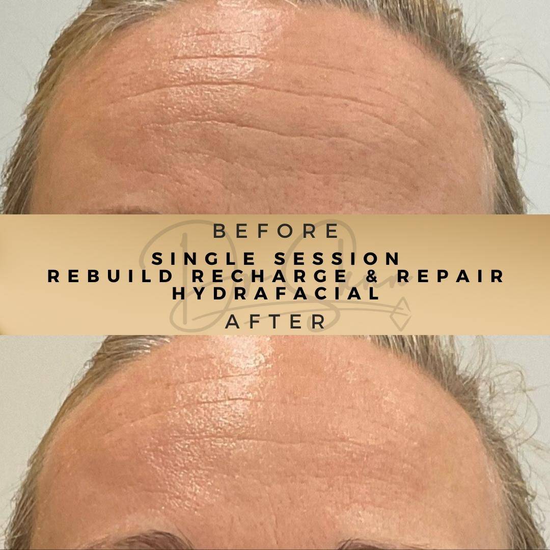 HydraFacial - Dr Sknn before and after