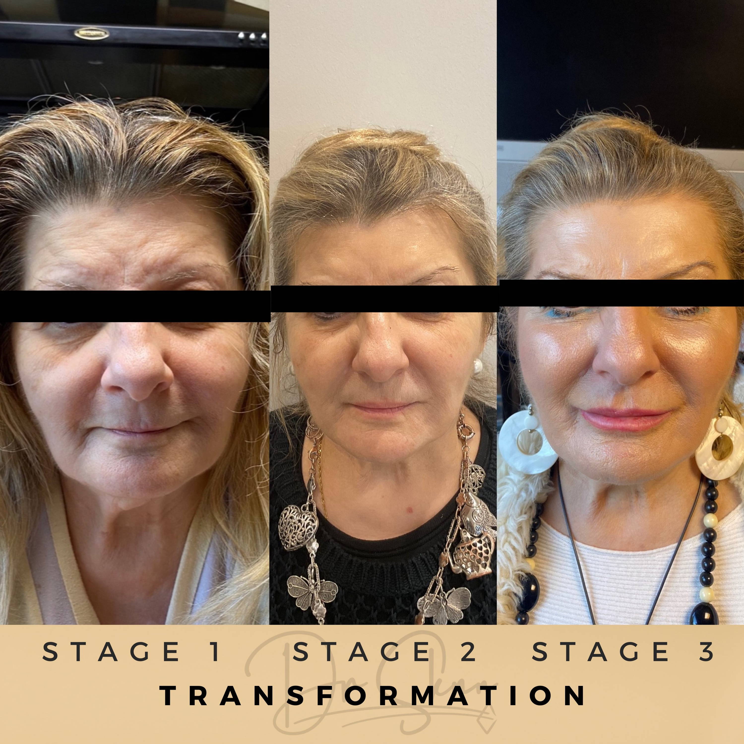 Transformations Aesthetic Clinic Wilmslow Before & After Dr Sknn