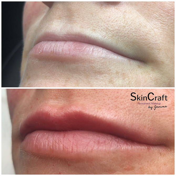 DERMAL FILLERS | Skincraft