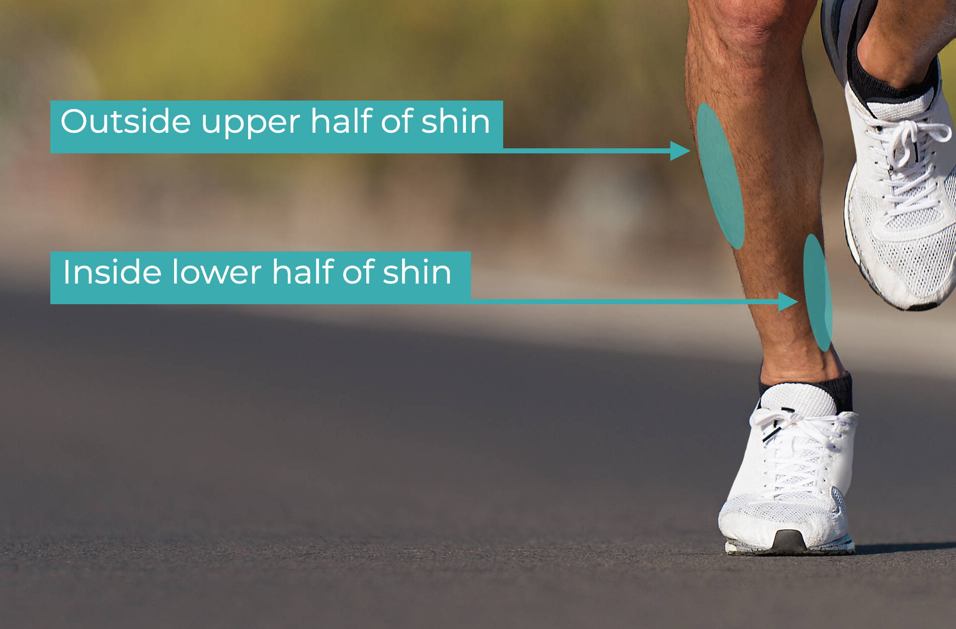 anterior tibial stress syndrome vs posterior tibial stress syndrome