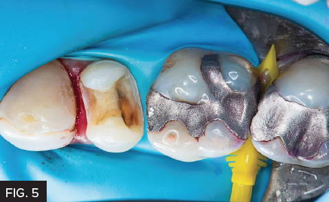 Fig. 5) The Bioclear non-retentive preparation is complete. Note that all sharp edges are removed and the dentin has been “blasted” with aluminum tri-hydroxide.