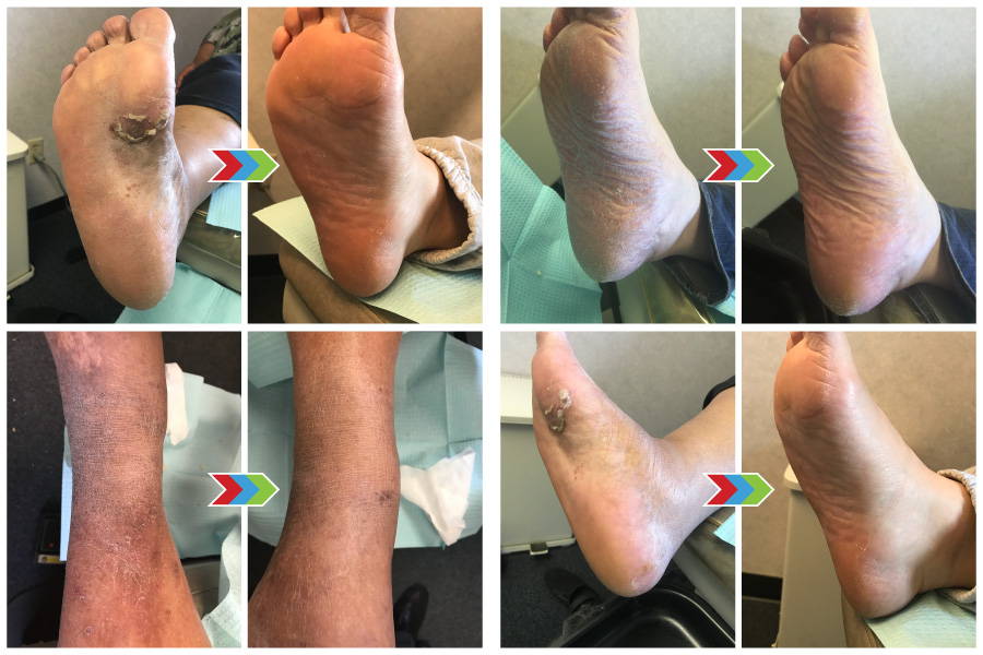 Diabetes Support Wipes amazing before and after pictures showing progress with dry skin.
