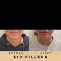 Lip Fillers Wilmslow with Anti-wrinkle injections