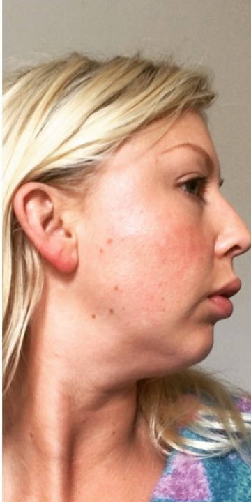 WunderHaut Anti-Aging Genius™ mit Radiofrequenz, LED Licht- und Mesotherapie, EMS und Elektroporation