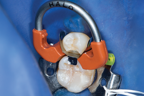 Halo ring in place along with band, wedge and clamps