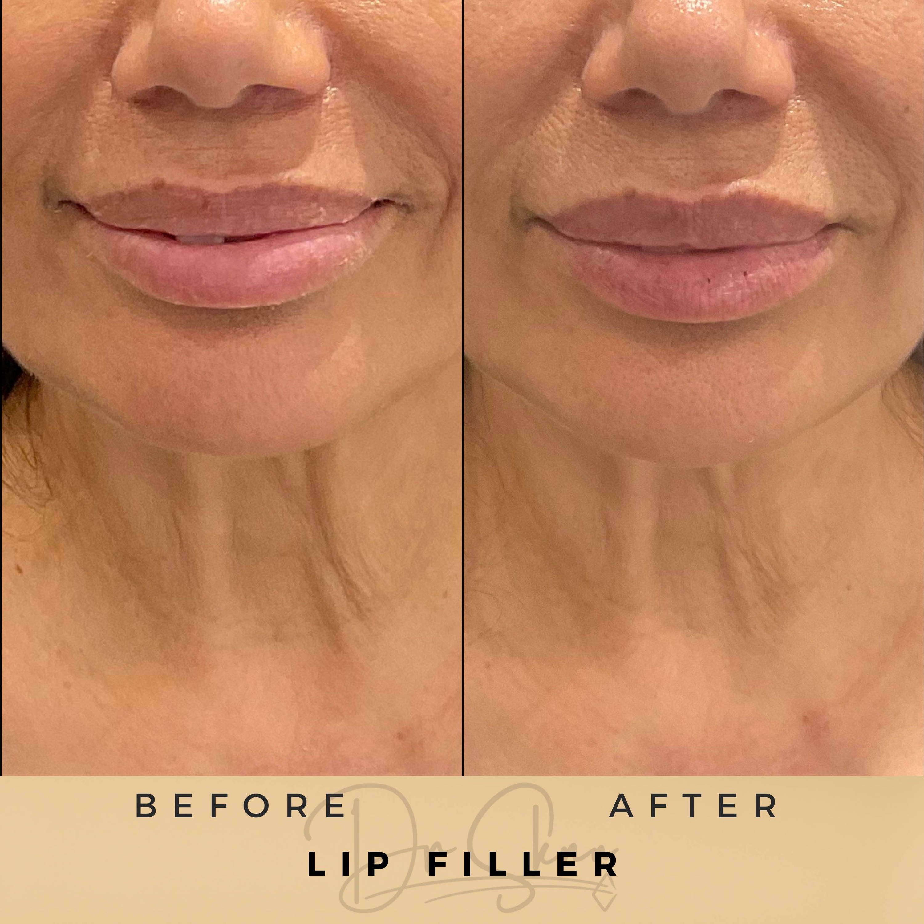 Lip Fillers Wilmslow Before & After Dr Sknn