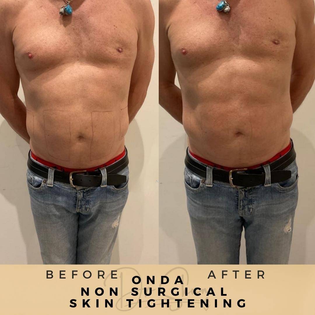 Skin Tightening - Non-surgical - Dr Sknn before and after
