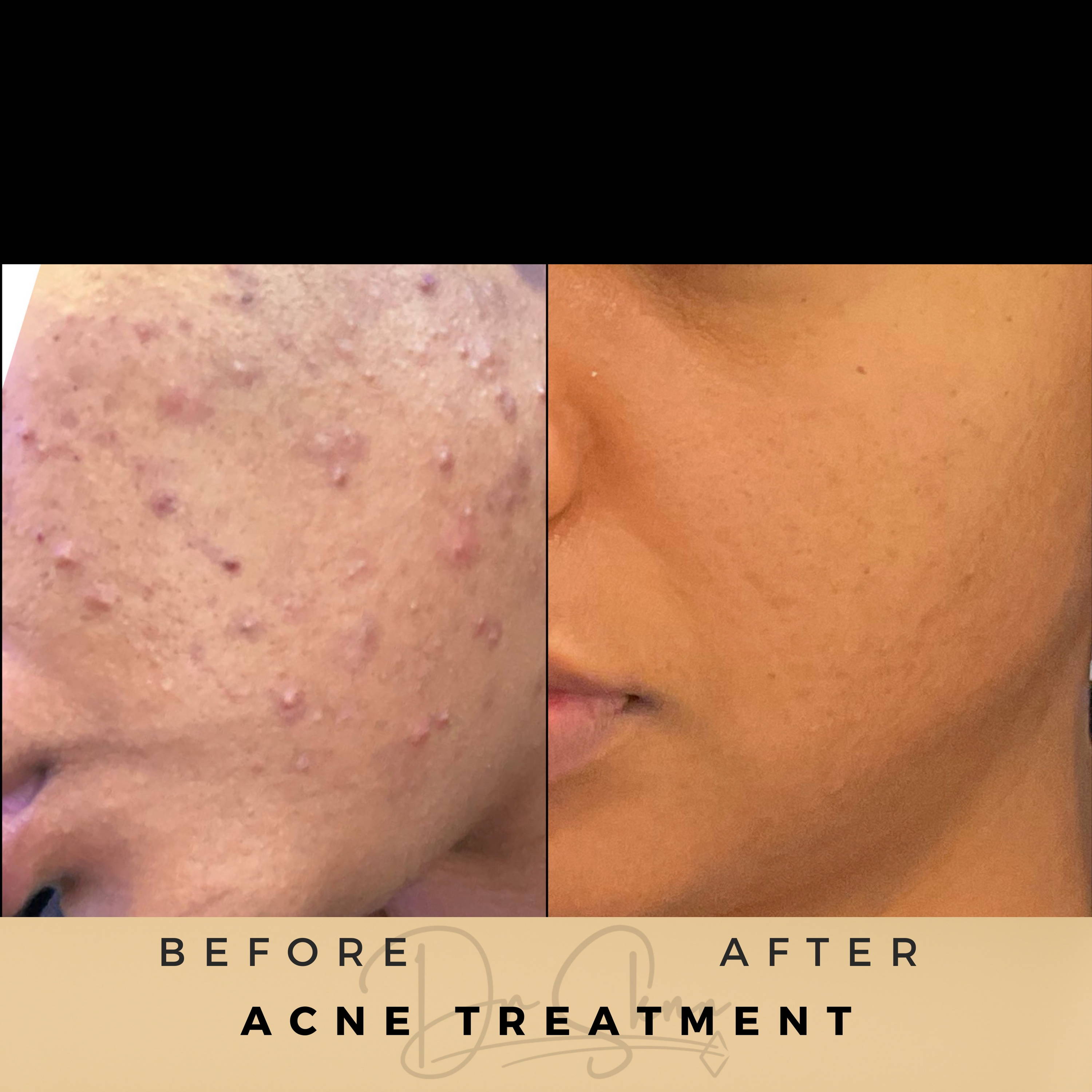 Acne Treatment - Dr Sknn before and after
