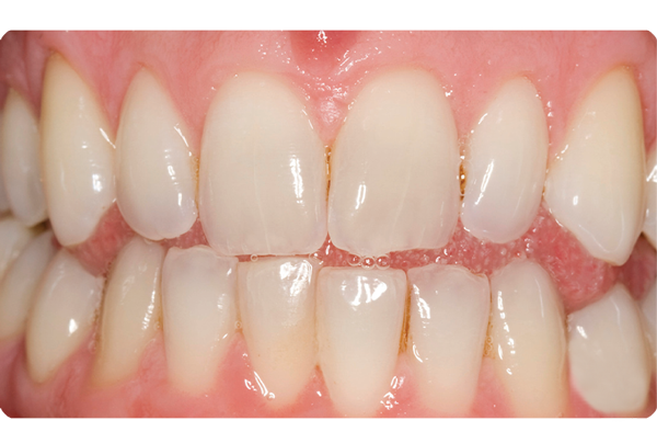 Opalescence Teeth: before