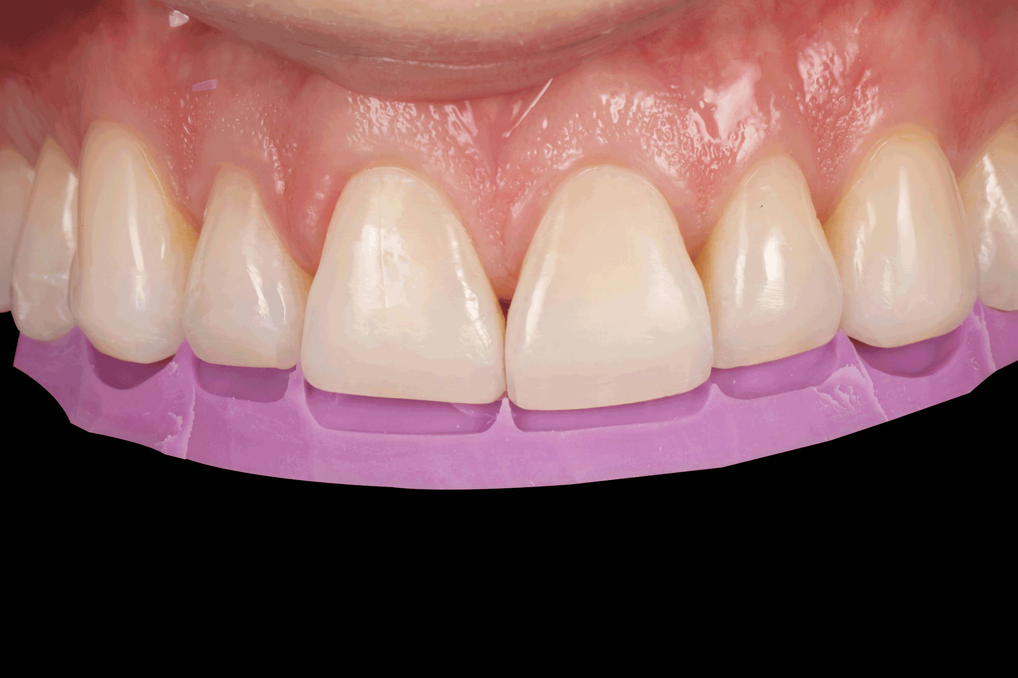 upper teeth in purple matrix material
