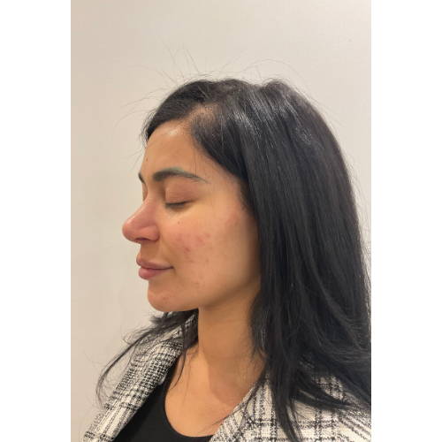 Dr Sknn Lip Fillers Before