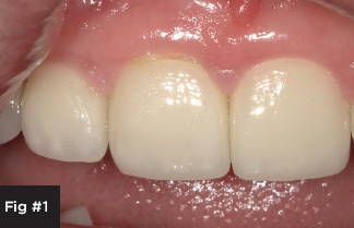 Patient presented with a defective margin and slight caries on the buccal of an old veneer on tooth number 8