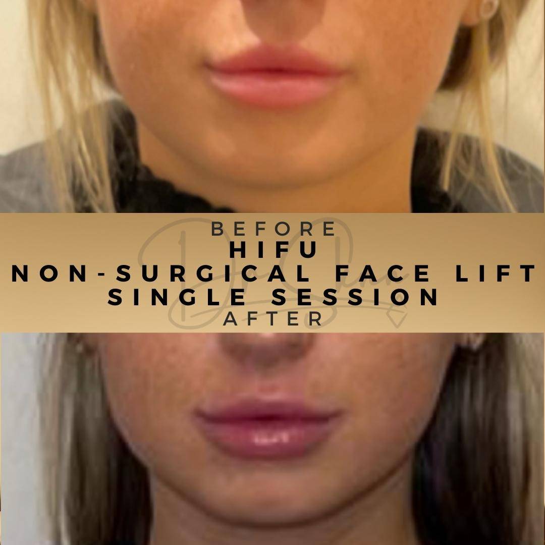 Non-surgical Facelift (HIFU) - Dr Sknn before and after