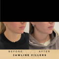 Jaw Fillers Wilmslow Before & After Dr Sknn