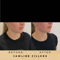 Jaw Fillers Wilmslow Before & After Dr Sknn