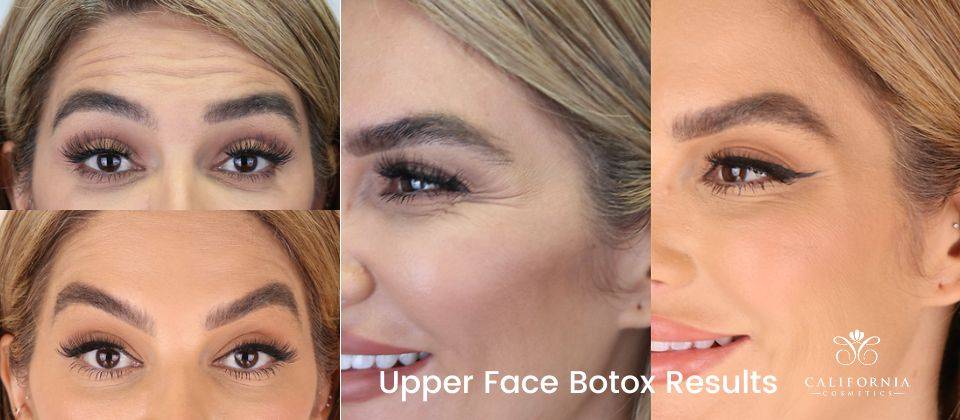 botox, juvederm before and after images