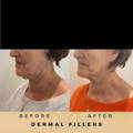 Jowl Fillers Wilmslow Dr Sknn Before & After Picture