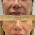 Liquid Facelift Wilmslow with Anti-wrinkle injections
