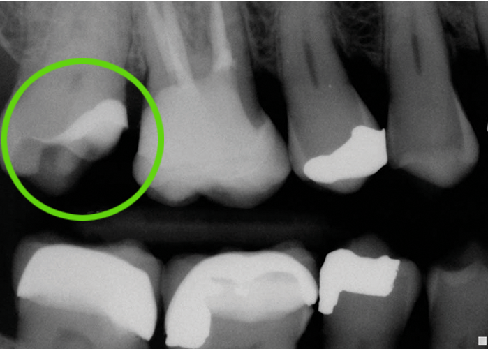 Teeth x-ray with green circle highlighting with less deep missing tooth piece