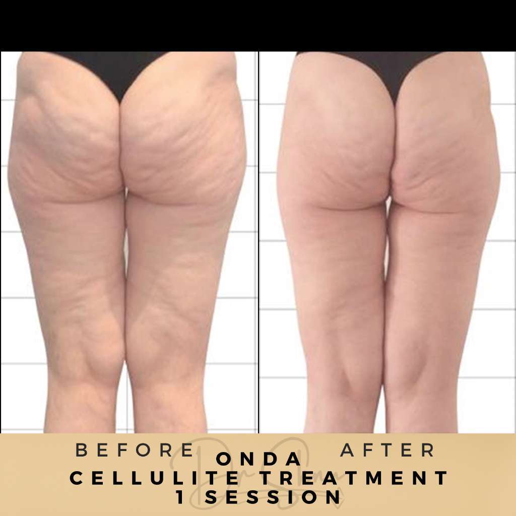 Cellulite Treatment Wilmslow Before & After Pictures Dr Sknn - Onda treatment
