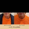 Lip Fillers Wilmslow with Anti-wrinkle injections
