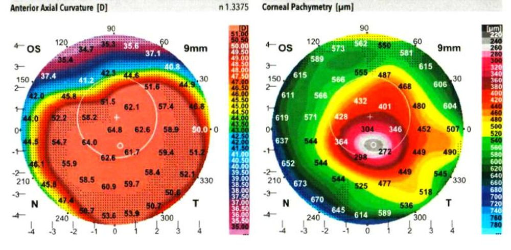 Cornea maps for stage 4 of keratoconus