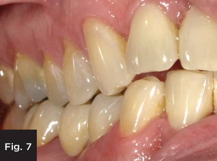 the buccal view of the final monolithic zirconia restoration