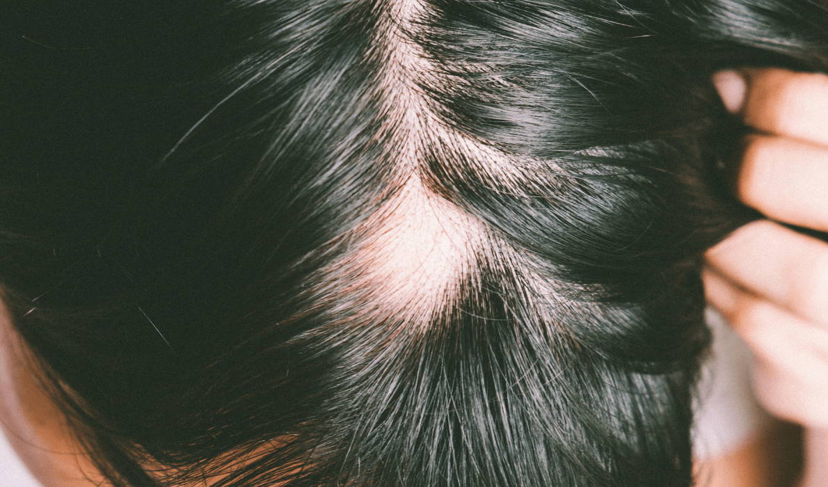 can Laser Therapy help with Alopecia Areata