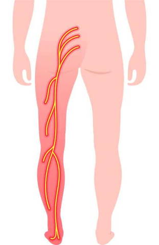 Infographic showing sciatic nerve in pain
