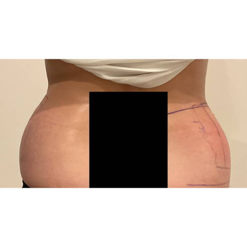 ONDA - Non-surgical Skin Tightening / Fat Reduction - Three Area - AFTER