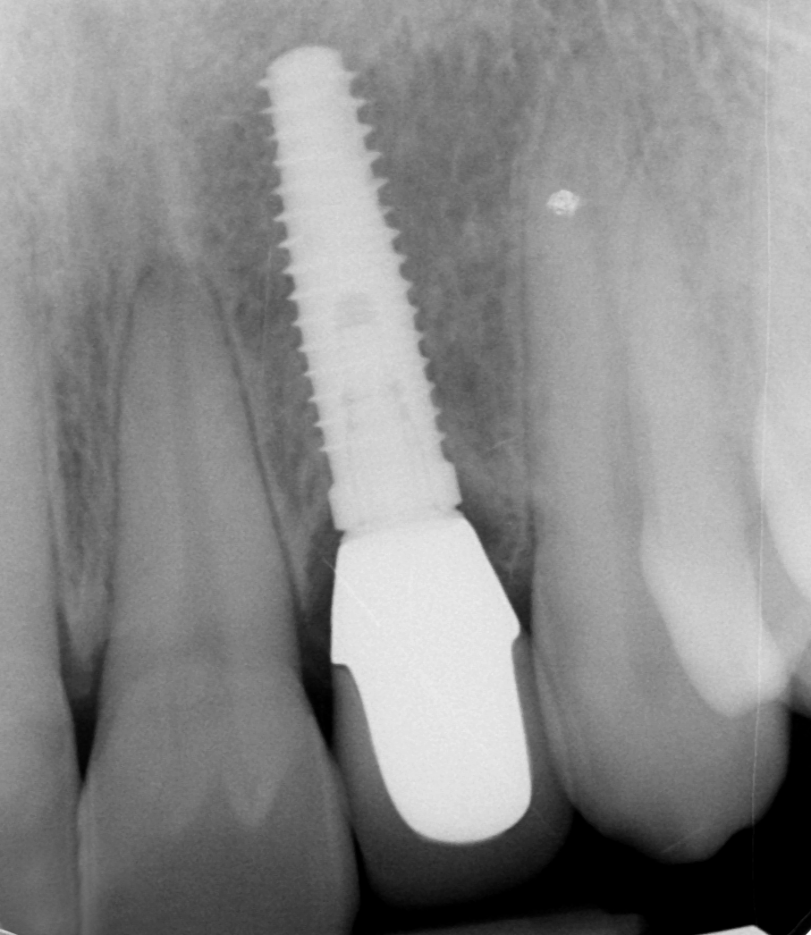 X-ray of teeth after treatment completion