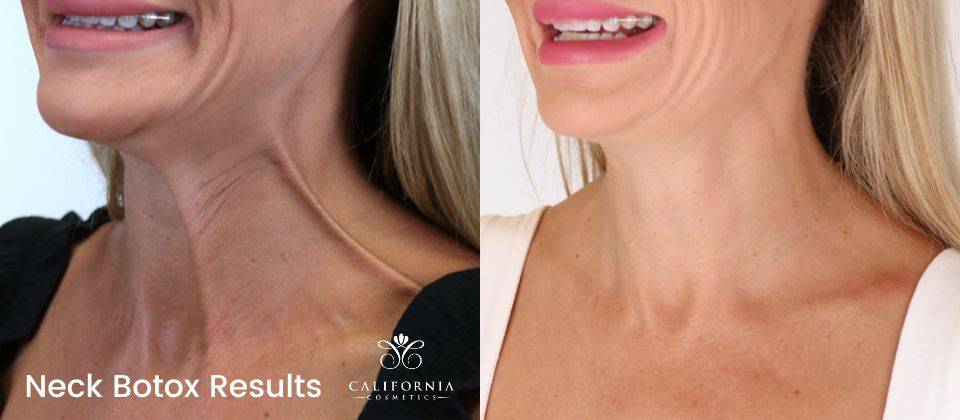 botox, juvederm before and after images